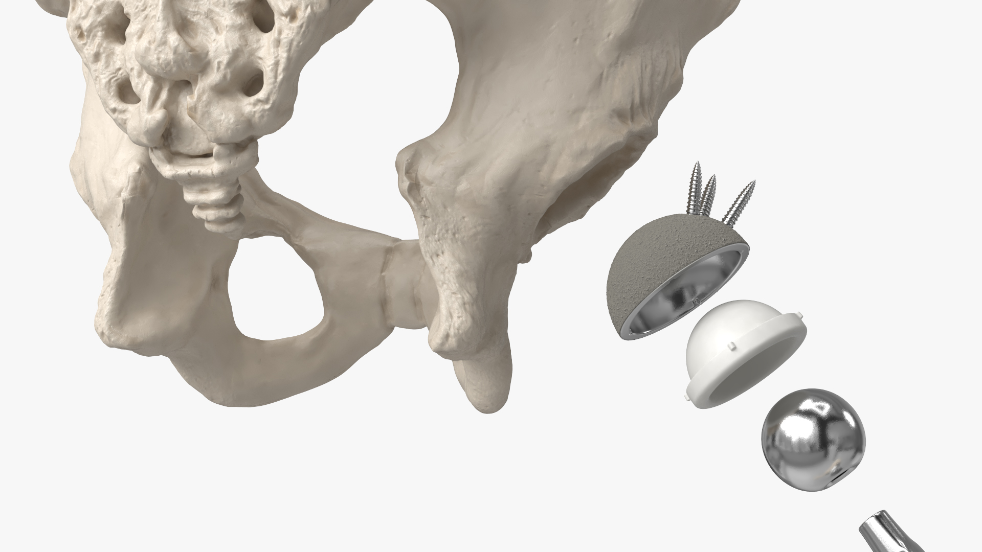 Hip Joint Implant with Pelvic Bone and Femur, view 6