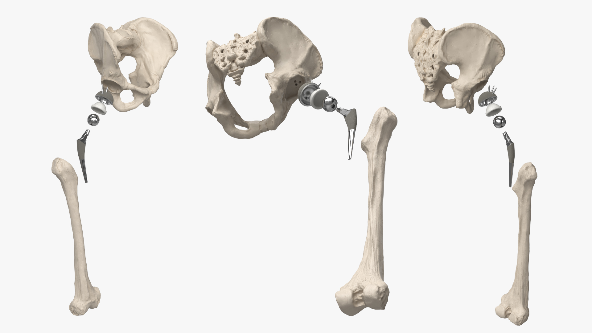 Hip Joint Implant with Pelvic Bone and Femur, view 3