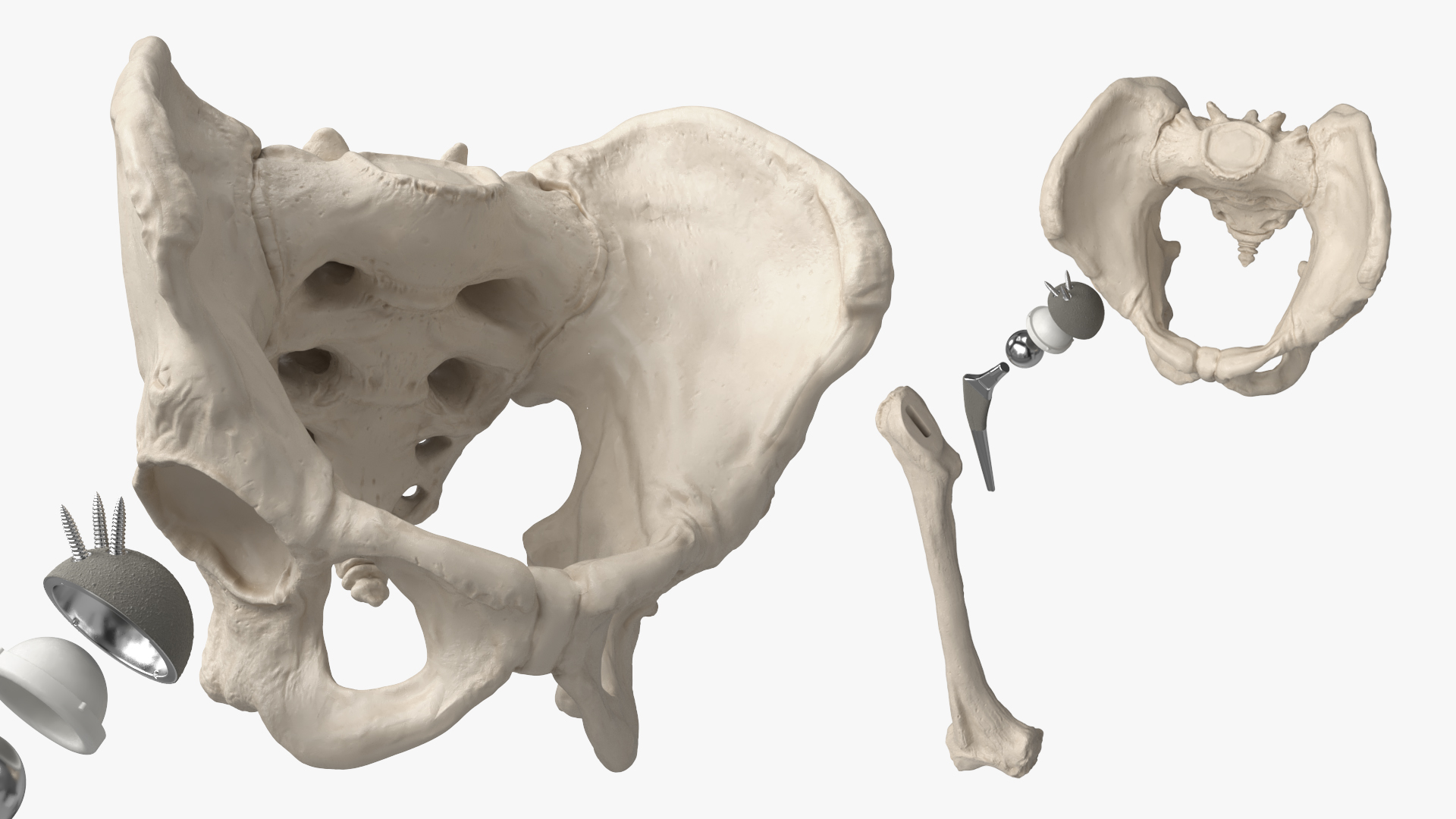 Hip Joint Implant with Pelvic Bone and Femur, view 4