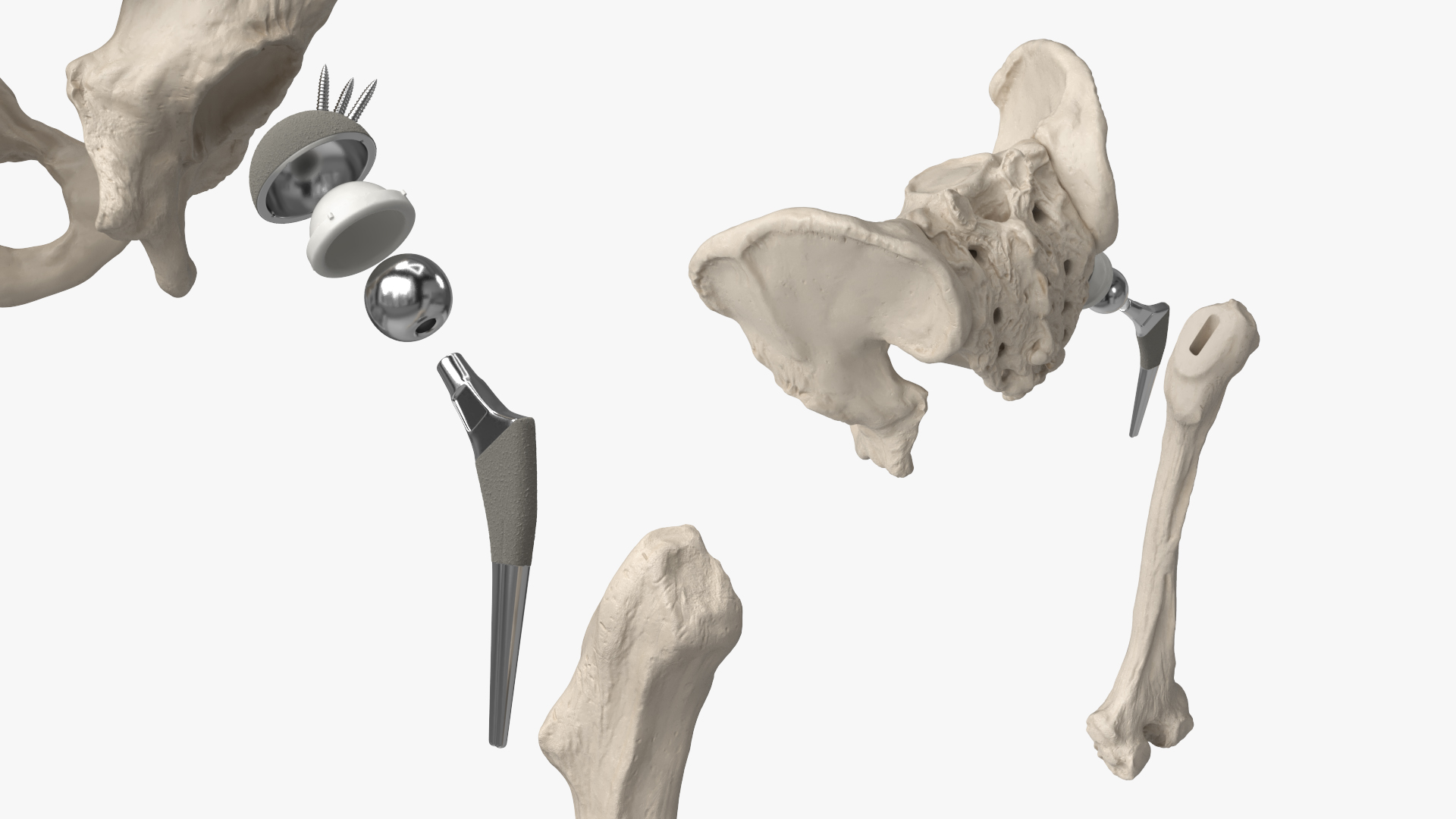 Hip Joint Implant with Pelvic Bone and Femur, view 5