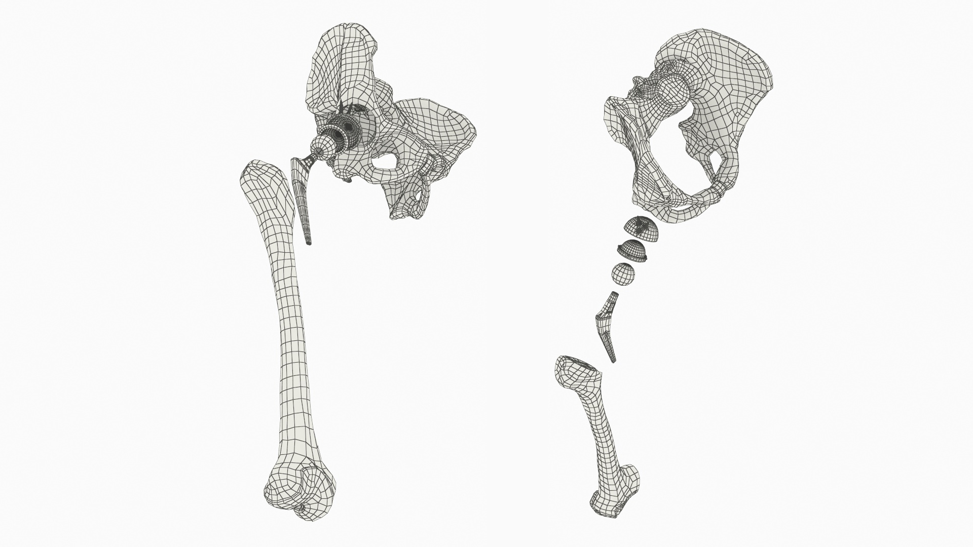Hip Joint Implant with Pelvic Bone and Femur, view 10