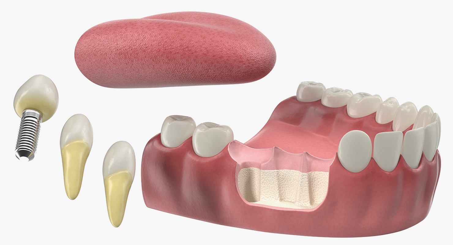 3D Teeth Tongue Medical Model With Dental Implant
